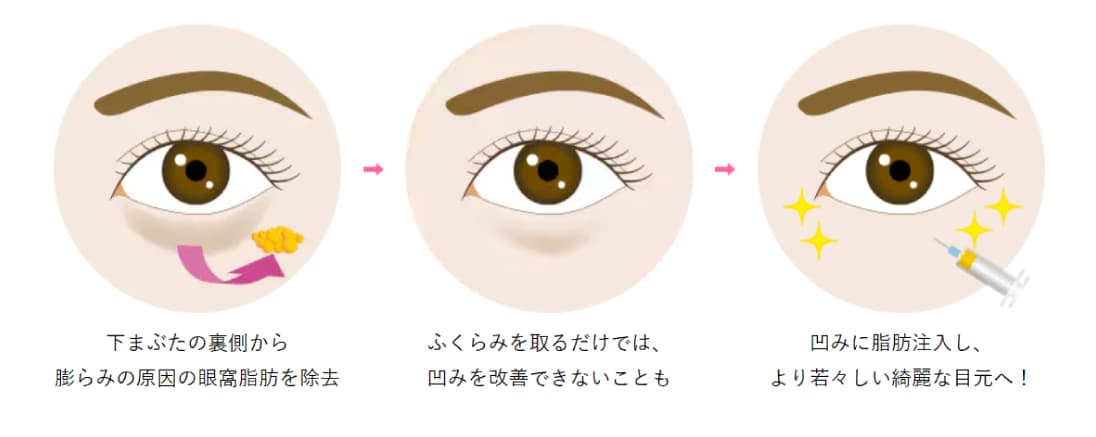 A.目の下の凹凸を綺麗にする施術です